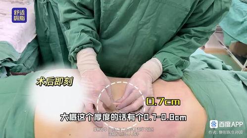 爆料桂哥抽脂视频大全下载,揭秘网红抽脂全过程  第2张