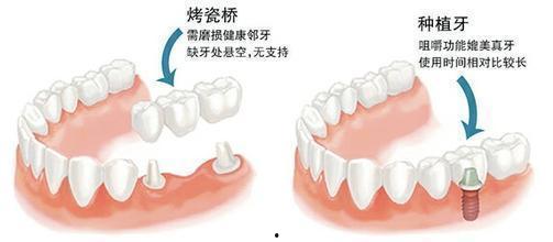 补牙全过程爆料视频大全,从检查到恢复，全方位视频解析  第3张